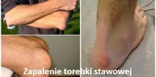 Zapalenie kaletki maziowej