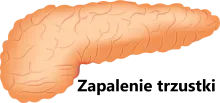 Zapalenie trzustki