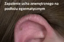 Zapalenie ucha zewnętrznego na podłożu egzematycznym, egzema ucha, wyprysk ucha