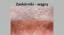 Zaskórniki, wągry