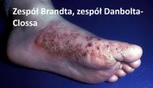 Zespół Brandta, zespół Danbolta-Clossa 