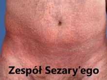 Zespół Sezary’ego
