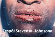 Zespół Stevensa- Johnsona