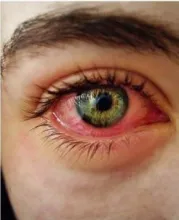 Zespół suchego oka