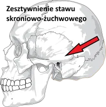 Zesztywnienie stawu skroniowo-żuchwowego 