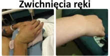Zwichnięcia ręki