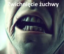 Zwichnięcie żuchwy