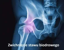 Zwichnięcie stawu biodrowego