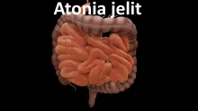 Atonia jelit 