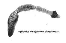 bąblowica wielojamowa, alweokokoza