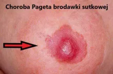 choroba Pageta brodawki sutkowej