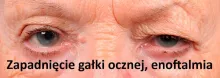 Zapadnięcie gałki ocznej, enoftalmia 
