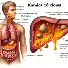 Kamica żółciowa