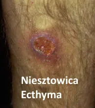  niesztowica ecthyma