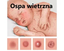 ospa, ospa wietrzna