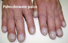 Pałeczkowate palce, pałeczkowatość palców