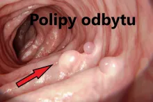 Polipy odbytu, polipy odbytnicy