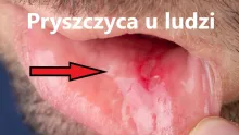 Pryszczyca u ludzi