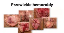 Przewlekłe hemoroidy