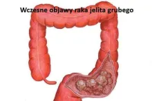 Wczesne objawy raka jelita grubego