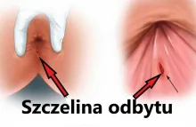 szczelina odbytu 