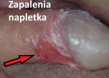 Zapalenie napletka