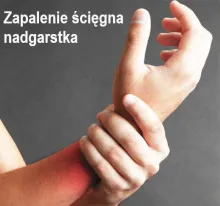 zapalenie ścięgna nadgarstka