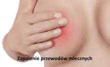 Zapalenie przewodów mlecznych
