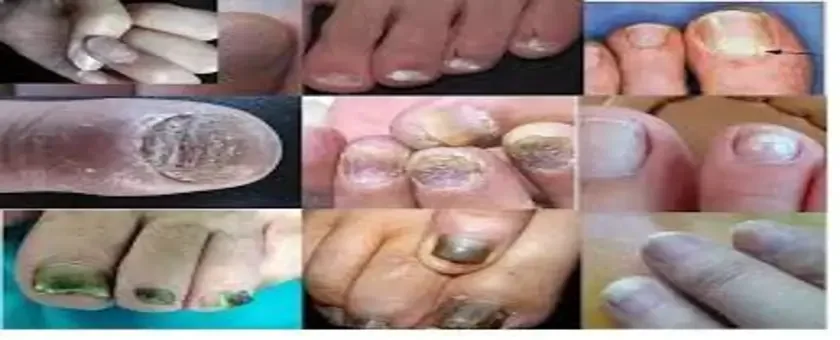 choroby paznokci