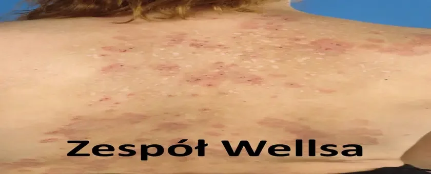 Eozynofilowe zapalenie tkanki podskórnej, zespół Wellsa
