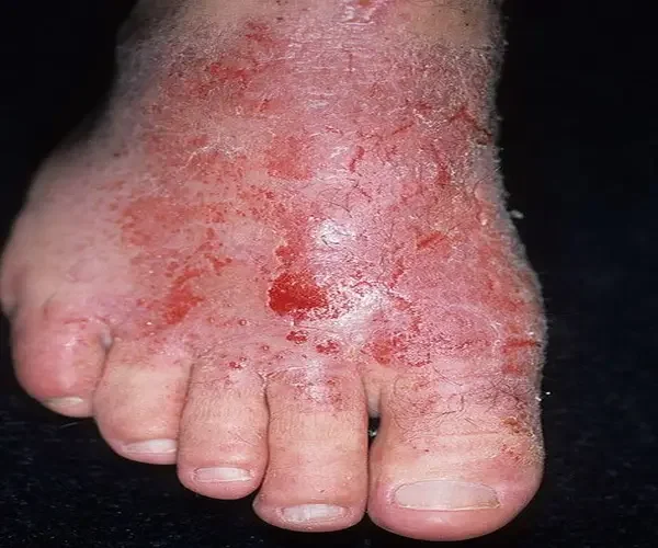 Atopowe zapalenie skóry stopy