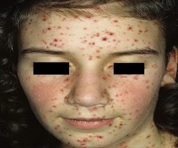 Choroba ospa na twarzy