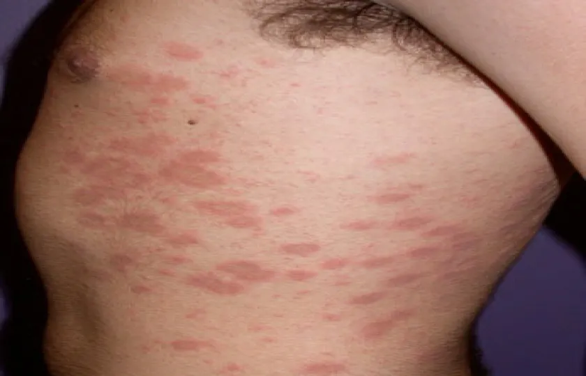 Łupież różowy Gilberta