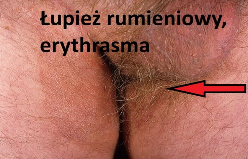 Łupież rumieniowy, erythrasma 