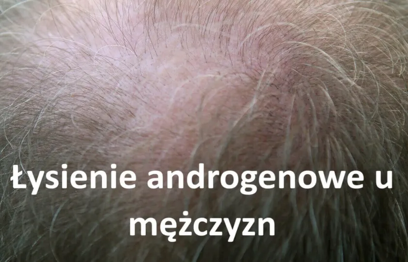 Łysienie androgenowe u mężczyzn