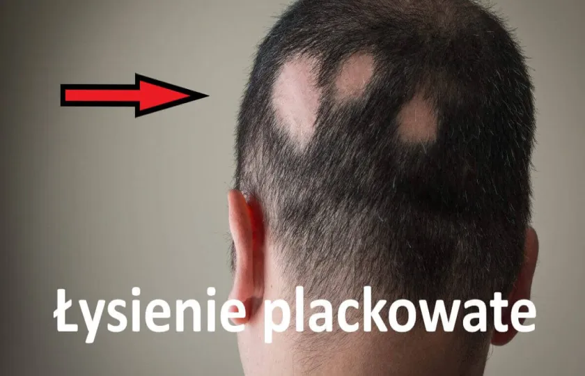 Łysienie plackowate 