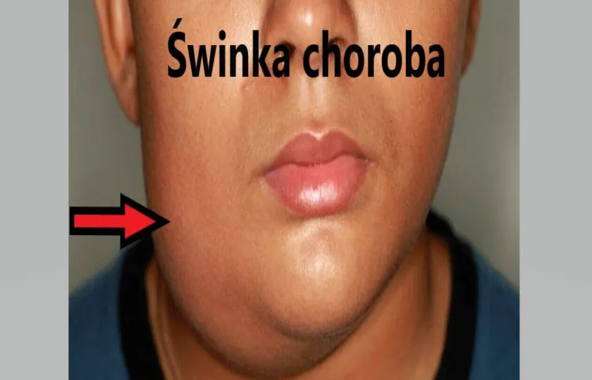 Świnka choroba