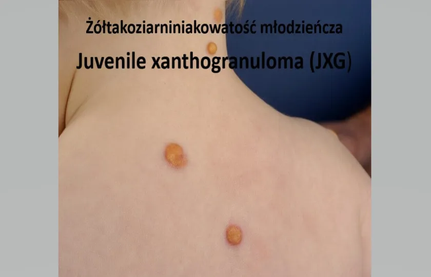 Żółtakoziarniniakowatość młodzieńcza 