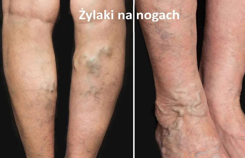 Żylaki na nogach, żylaki kończyn dolnych