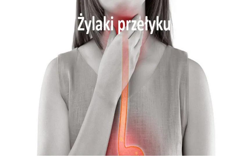 Żylaki przełyku