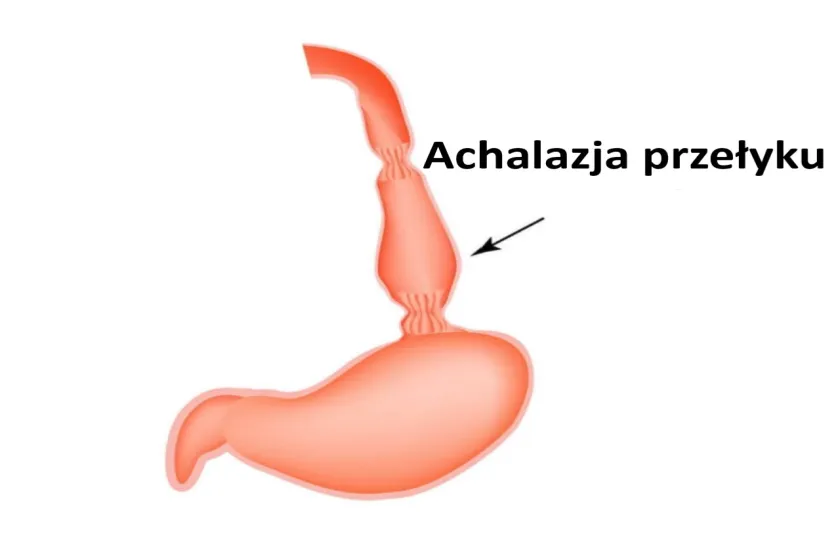 Achalazja przełyku, achalazja wpustu, kurcz wpustu 