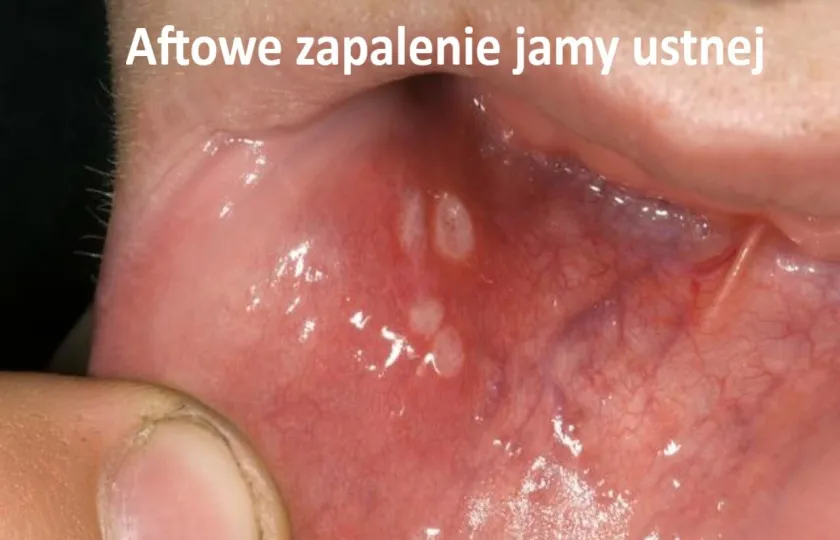 Aftowe zapalenie jamy ustnej, aftoza 