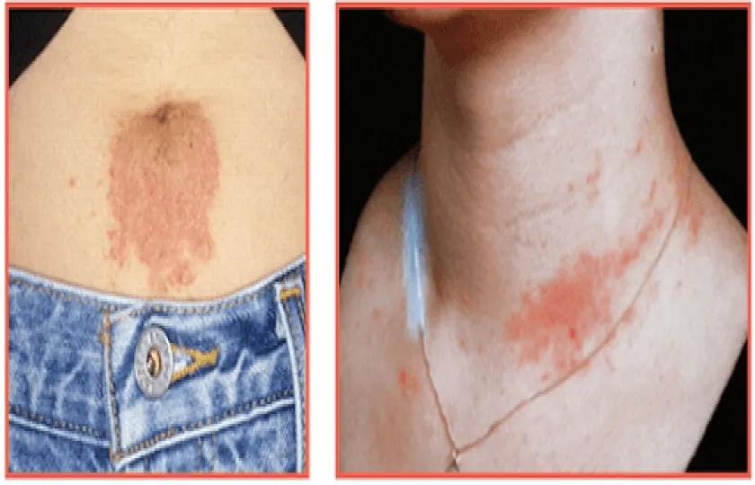 Alergiczne kontaktowe zapalenie skóry 