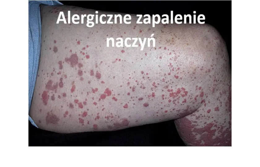Alergiczne zapalenie naczyń 