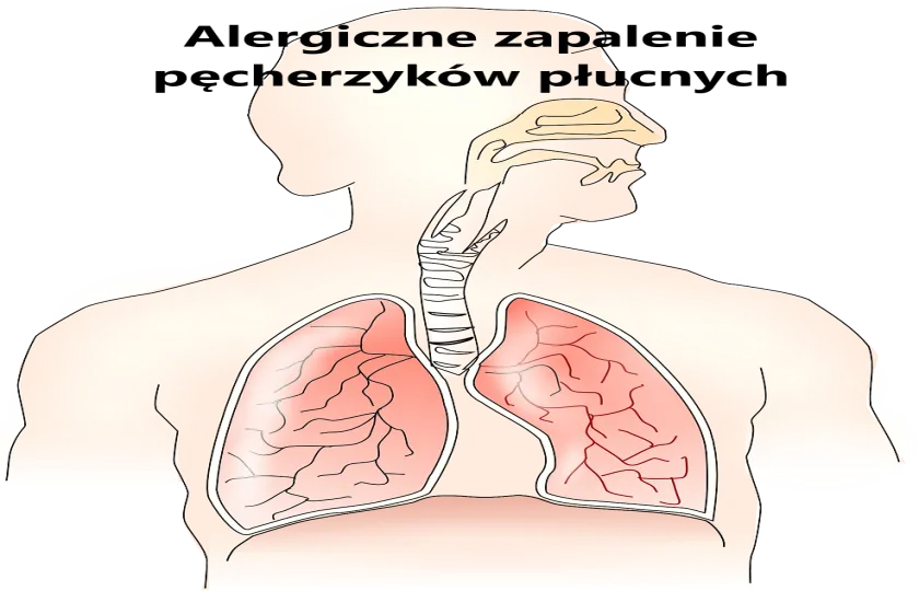 Alergiczne zapalenie pęcherzyków płucnych