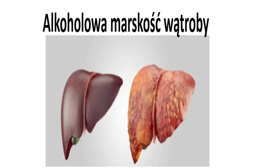 Alkoholowa marskość wątroby 