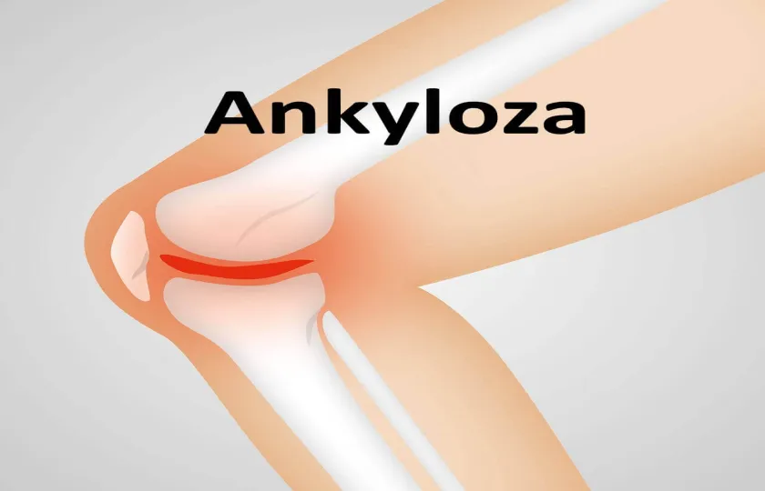 Ankyloza 