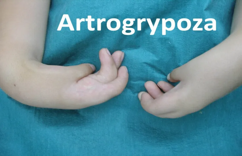 Artrogrypoza 