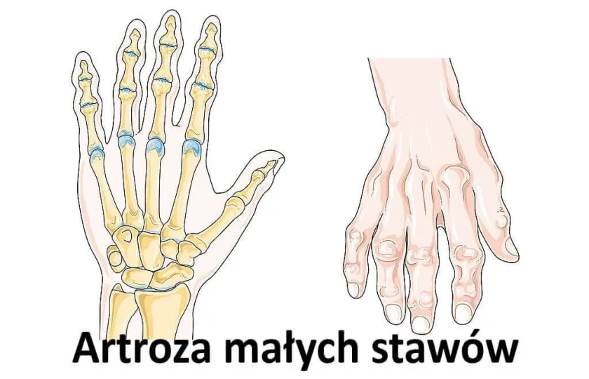 ARTROZA MAŁYCH STAWÓW RĄK I STÓP 