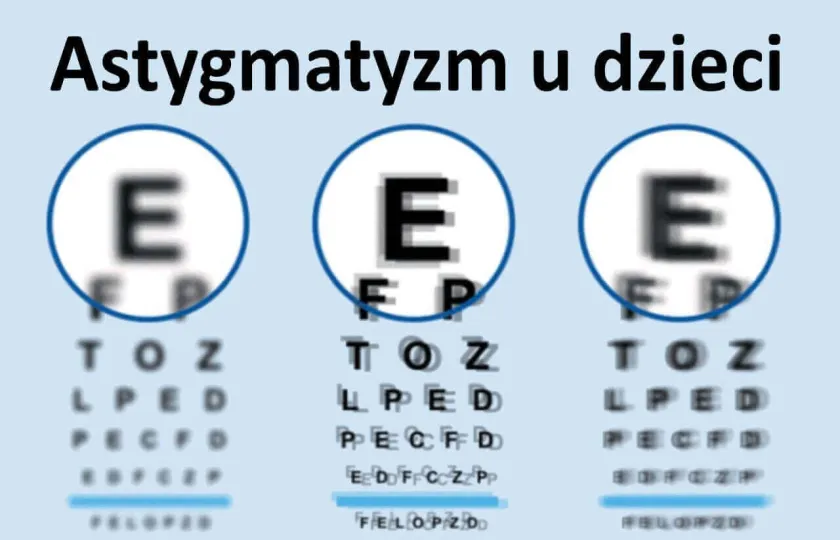 Astygmatyzm u dzieci 